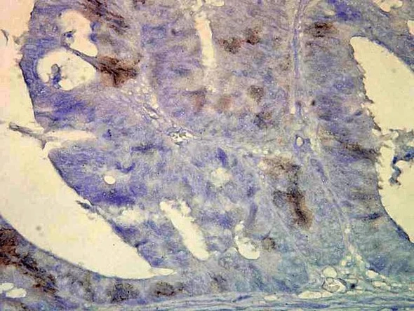 Immunohistochemistry analysis using Mouse Anti-Hsp70 Monoclonal Antibody, Clone BB70 (STMA00004). Tissue: colon carcinoma. Species: Human. Fixation: Formalin. Primary Antibody: Mouse Anti-Hsp70 Monoclonal Antibody (STMA00004) at 1:10000 for 12 hours at 4°C. Secondary Antibody: Biotin Goat Anti-Mouse at 1:2000 for 1 hour at RT. Counterstain: Mayer Hematoxylin (purple/blue) nuclear stain at 200 µl for 2 minutes at RT.