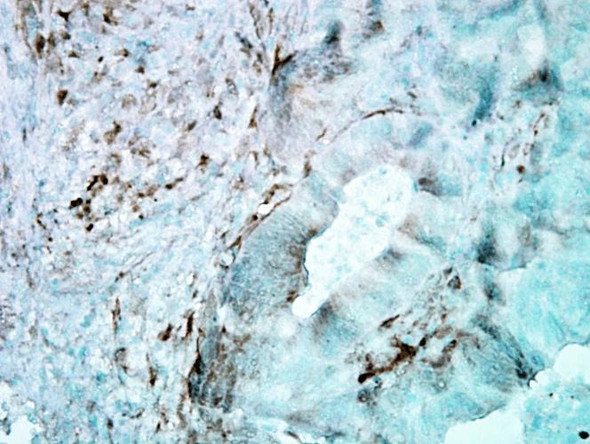Immunohistochemistry analysis using Mouse Anti-Hsp27 Monoclonal Antibody, Clone 8A7 (STMA00010). Tissue: colon carcinoma. Species: Human. Fixation: Formalin. Primary Antibody: Mouse Anti-Hsp27 Monoclonal Antibody (STMA00010) at 1:5000 for 12 hours at 4°C. Secondary Antibody: Biotin Goat Anti-Mouse at 1:2000 for 1 hour at RT. Counterstain: Mayer Hematoxylin (purple/blue) nuclear stain at 200 µl for 2 minutes at RT.