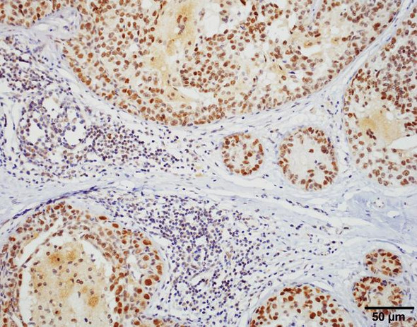 Immunohistochemistry analysis using Rat Anti-HSF1 Monoclonal Antibody, Clone 10H8 (STMA00012). Tissue: Breast carcinoma. Species: Human. Fixation: 10% Formalin Solution for 20 hours at RT. Primary Antibody: Rat Anti-HSF1 Monoclonal Antibody (STMA00012) at 1:1000 for 40 min. Secondary Antibody: Dako labeled Polymer HRP Anti-rat IgG, DAB Chromogen (brown) (Dako Envision+ System) for 30 min at RT.