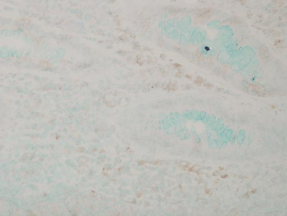 Immunohistochemistry analysis using Mouse Anti-p38 MAPK Monoclonal Antibody, Clone 9F12 (STMA00031). Tissue: colon carcinoma. Species: Human. Fixation: Formalin. Primary Antibody: Mouse Anti-p38 MAPK Monoclonal Antibody (STMA00031) at 1:10000 for 12 hours at 4°C. Secondary Antibody: Biotin Goat Anti-Mouse at 1:2000 for 1 hour at RT. Counterstain: Mayer Hematoxylin (purple/blue) nuclear stain at 200 µl for 2 minutes at RT. Magnification: 40x.