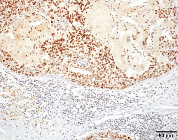 Immunohistochemistry analysis using Rat Anti-HSF1 Monoclonal Antibody, Clone 10H4 (STMA00162). Tissue: Breast carcinoma. Species: Human. Fixation: 10% Formalin Solution for 20 hours at RT. Primary Antibody: Rat Anti-HSF1 Monoclonal Antibody (STMA00162) at 1:8000 for 40 min. Secondary Antibody: Dako labeled Polymer HRP Anti-rat IgG, DAB Chromogen (brown) (Dako Envision+ System) for 30 min at RT.