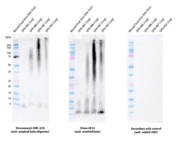 Immunohistochemistry (IHC) analysis on a temporal lobe section of a human Alzheimer’s diseased brain tissue. Block: 3% skim milk in PBST. Primary Antibody: Rabbit Anti-Amyloid Beta Oligomer Monoclonal Antibody, clone 1A2 (STMA00222) at 1:100. Secondary: Goat-anti-rabbit IgG:HRP at 1:100. Stained with DAB (1:50) and Hematoxylin (1:10).