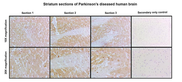 Immunohistochemistry analysis with Mouse Anti-Human Alpha Synuclein N-Terminal Monoclonal Antibody, Clone 11D4 (STMA00225). Tissue: Striatum sections of Parkinson’s Diseased Brain. Species: Human. Fixation: Paraffin embedded, 5um thin. Blocking: 3% milk for 1 hour at RT. Antigen Retrieval: Citrate buffer, pH 6.0, boiled for 20 min. Primary Antibody: Mouse Anti-Human Alpha Synuclein N-Terminal Monoclonal Antibody, Clone 11D4 (STMA00225).