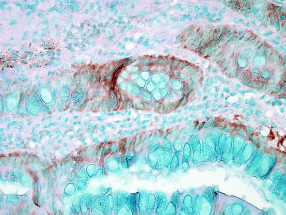 Immunohistochemistry analysis using Rabbit Anti-HSP70 Polyclonal Antibody (STPA00002). Tissue: colon carcinoma. Species: Human. Fixation: Formalin. Primary Antibody: Rabbit Anti-HSP70 Polyclonal Antibody (STPA00002) at 1:50000 for 12 hours at 4°C. Secondary Antibody: Biotin Goat Anti-Rabbit at 1:2000 for 1 hour at RT. Counterstain: Methyl Green at 200uL for 2 min at RT.