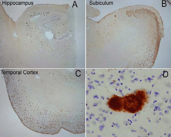 Immunohistochemistry analysis using Rabbit Anti-Amyloid Fibrils (OC) Polyclonal Antibody (STPA00056). Tissue: Alzheimer's Disease brain. Species: Human. Primary Antibody: Rabbit Anti-Amyloid Fibrils (OC) Polyclonal Antibody (STPA00056) at 1:100. Extensive OC labeling was observed in the hippocampus (A), subiculum (B) and frontal cortex (C) in Alzheimer disease.