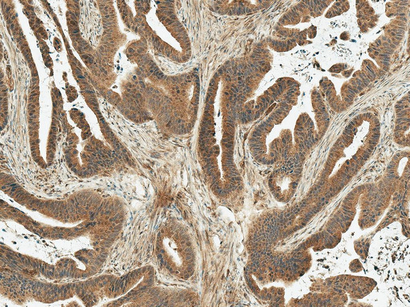 Immunohistochemistry analysis using Rabbit Anti-MDM2 Polyclonal Antibody (STPA00083). Tissue: Stomach Cancer. Species: Human. Fixation: Formalin Fixed Paraffin-Embedded. Primary Antibody: Rabbit Anti-MDM2 Polyclonal Antibody (STPA00083) at 1:50 for 30 min at RT. Counterstain: Hematoxylin. Magnification: 10X. HRP-DAB Detection.