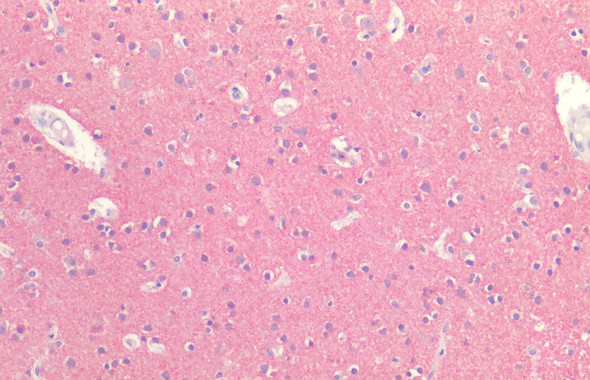 Immunohistochemistry analysis using Rabbit Anti-Tau Polyclonal Antibody (STPA00088). Tissue: Brain Cortex. Species: Human. Fixation: Formalin fixed paraffin-embedded. Primary Antibody: Rabbit Anti-Tau Polyclonal Antibody (STPA00088).
