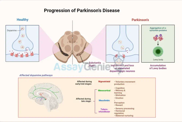 Die Parkinson-Krankheit verstehen: Erkenntnisse und Innovationen