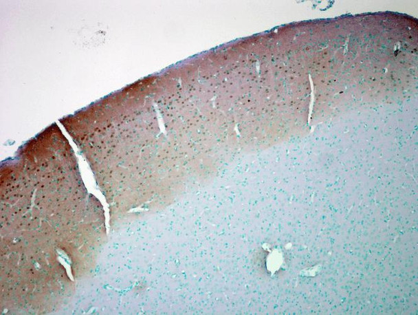 Immunohistochemistry analysis using Mouse Anti-CaMKII Monoclonal Antibody, Clone 6G9 (STMA00015). Tissue: colon carcinoma. Species: Human. Fixation: Formalin. Primary Antibody: Mouse Anti-CaMKII Monoclonal Antibody (STMA00015) at 1:10000 for 12 hours at 4°C. Secondary Antibody: Biotin Goat Anti-Mouse at 1:2000 for 1 hour at RT. Counterstain: Mayer Hematoxylin (purple/blue) nuclear stain at 200 µl for 2 minutes at RT. Magnification: 40x.