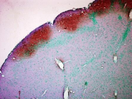 Immunohistochemistry analysis using Mouse Anti-CaMKII Monoclonal Antibody, Clone 22B1 (STMA00016). Tissue: colon carcinoma. Species: Human. Fixation: Formalin. Primary Antibody: Mouse Anti-CaMKII Monoclonal Antibody (STMA00016) at 1:5000 for 12 hours at 4°C. Secondary Antibody: Biotin Goat Anti-Mouse at 1:2000 for 1 hour at RT. Counterstain: Mayer Hematoxylin (purple/blue) nuclear stain at 200 µl for 2 minutes at RT. Magnification: 40x.