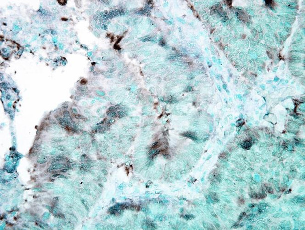 Immunohistochemistry analysis using Mouse Anti-Hsp90 Monoclonal Antibody, Clone 4F3.E8 (STMA00028). Tissue: colon carcinoma. Species: Human. Fixation: Formalin. Primary Antibody: Mouse Anti-Hsp90 Monoclonal Antibody (STMA00028) at 1:100000 for 12 hours at 4°C. Secondary Antibody: Biotin Goat Anti-Mouse at 1:2000 for 1 hour at RT. Counterstain: Mayer Hematoxylin (purple/blue) nuclear stain at 200 µl for 2 minutes at RT.