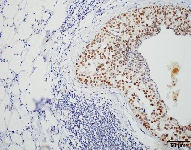 Immunohistochemistry analysis using Rat Anti-HSF1 Monoclonal Antibody, Clone 4B4 (STMA00163). Tissue: Breast carcinoma. Species: Human. Fixation: 10% Formalin Solution for 20 hours at RT. Primary Antibody: Rat Anti-HSF1 Monoclonal Antibody (STMA00163) at 1:2000 for 40 min. Secondary Antibody: Dako labeled Polymer HRP Anti-rat IgG, DAB Chromogen (brown) (Dako Envision+ System) for 30 min at RT.