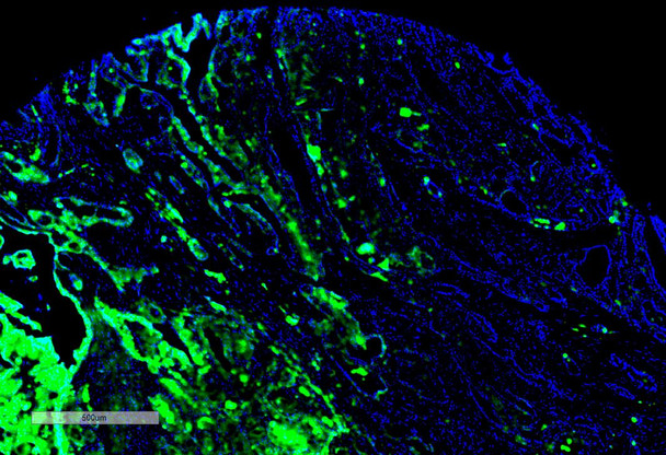 Immunohistochemistry analysis using Mouse Anti-Thyroid Hormone Receptor Monoclonal Antibody, Clone H43 (STMA00204). Tissue: Thyroid Cancer. Species: Human. Primary Antibody: Mouse Anti-Thyroid Hormone Receptor Monoclonal Antibody (STMA00204) at 1:100 for Overnight at 4C, then 30 min at 37C. Secondary Antibody: Goat Anti-Mouse IgG (H+L): FITC for 45 min at 37C. Counterstain: DAPI for 3 min at RT. Magnification: 4X.