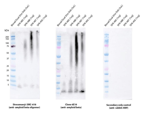 Immunohistochemistry (IHC) analysis on a temporal lobe section of a human Alzheimer’s diseased brain tissue. Block: 3% skim milk in PBST. Primary Antibody: Rabbit Anti-Amyloid Beta Oligomer Monoclonal Antibody, clone 1A2 (STMA00222) at 1:100. Secondary: Goat-anti-rabbit IgG:HRP at 1:100. Stained with DAB (1:50) and Hematoxylin (1:10).