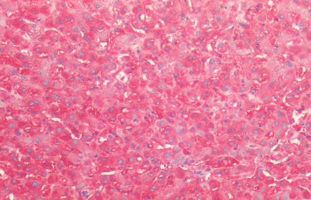 Immunohistochemistry analysis using Rabbit Anti-HSP60 Polyclonal Antibody (STPA00033). Tissue: Liver. Species: Human. Fixation: Formalin fixed paraffin-embedded. Primary Antibody: Rabbit Anti-HSP60 Polyclonal Antibody (STPA00033).