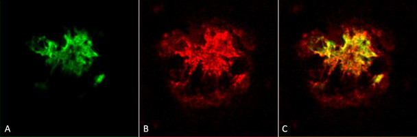 Immunohistochemistry analysis using Rabbit Anti-Amyloid Oligomers (A11) Polyclonal Antibody (STPA00055). Tissue: Alzheimer's Disease brain. Species: Human. Fixation: Formalin fixed. Primary Antibody: Rabbit Anti-Amyloid Oligomers (A11) Polyclonal Antibody (STPA00055) at 1:1000. Secondary Antibody: Goat Anti-Rabbit ATTO 594 (red). Localization: Plaque. (A) Amyloid Fibril (OC) Antibody (STPA00056). (B) Amyloid Oligomer (A11) Antibody (STPA00055).