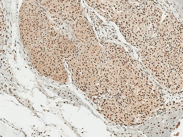 Immunohistochemistry analysis using Rabbit Anti-Alpha Synuclein pSer129 Polyclonal Antibody (STPA00078). Tissue: Brain. Species: Human. Fixation: Formalin Fixed Paraffin-Embedded. Primary Antibody: Rabbit Anti-Alpha Synuclein pSer129 Polyclonal Antibody (STPA00078) at 1:50 for 30 min at RT. Counterstain: Hematoxylin. Magnification: 10X. HRP-DAB Detection.