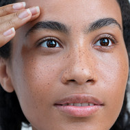 Common Causes of Hyperpigmentation