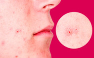 Why Some Acne Treatments Don t Work