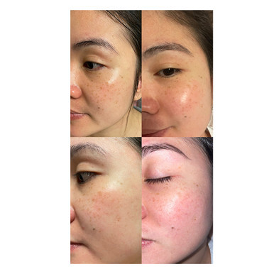 Professional Hyperpigmentation Treatment Set - Safe & Effective Treatment, Now Comes with a Free Relumins Wood Brush!