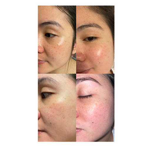 Professional Hyperpigmentation Treatment Set - Safe & Effective Treatment, Now Comes with a Free Relumins Wood Brush!