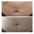 NEW! Meso Stretch Mark Remover - Stimulates Wound Healing and Tissue Regeneration