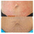 NEW! Meso Stretch Mark Remover - Stimulates Wound Healing and Tissue Regeneration
