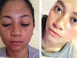 Relumins Professional Acne Clear Set with Acne Fighting Botanicals