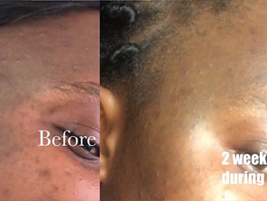 Relumins Glutathione Vials - New Advanced Formula 15000mg