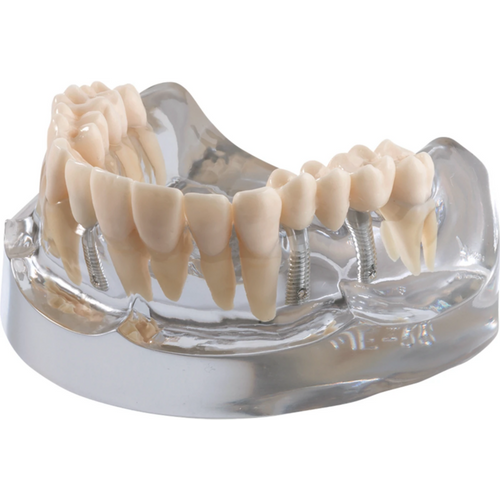 Implantatmodell overkjeve med krone + bro iP12-SB10 stk.