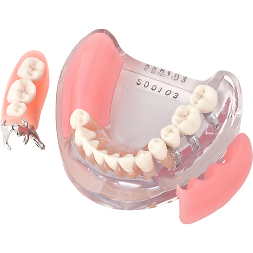 Implantatmodell UK med krone + protese iP9-3100 stk.