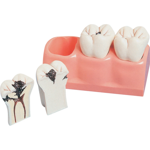 Caries model P13-TR7 stk.