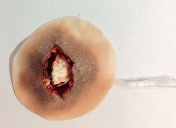 Open Wrist Fracture, 800-602