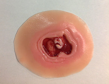 Diabetic Ulcer 20 mm, 800-661