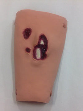 Tibia /Compound Fracture, 800-6761