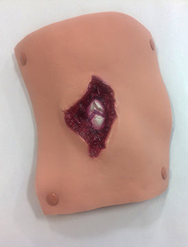 Compound Fracture Humerus, 800-6816