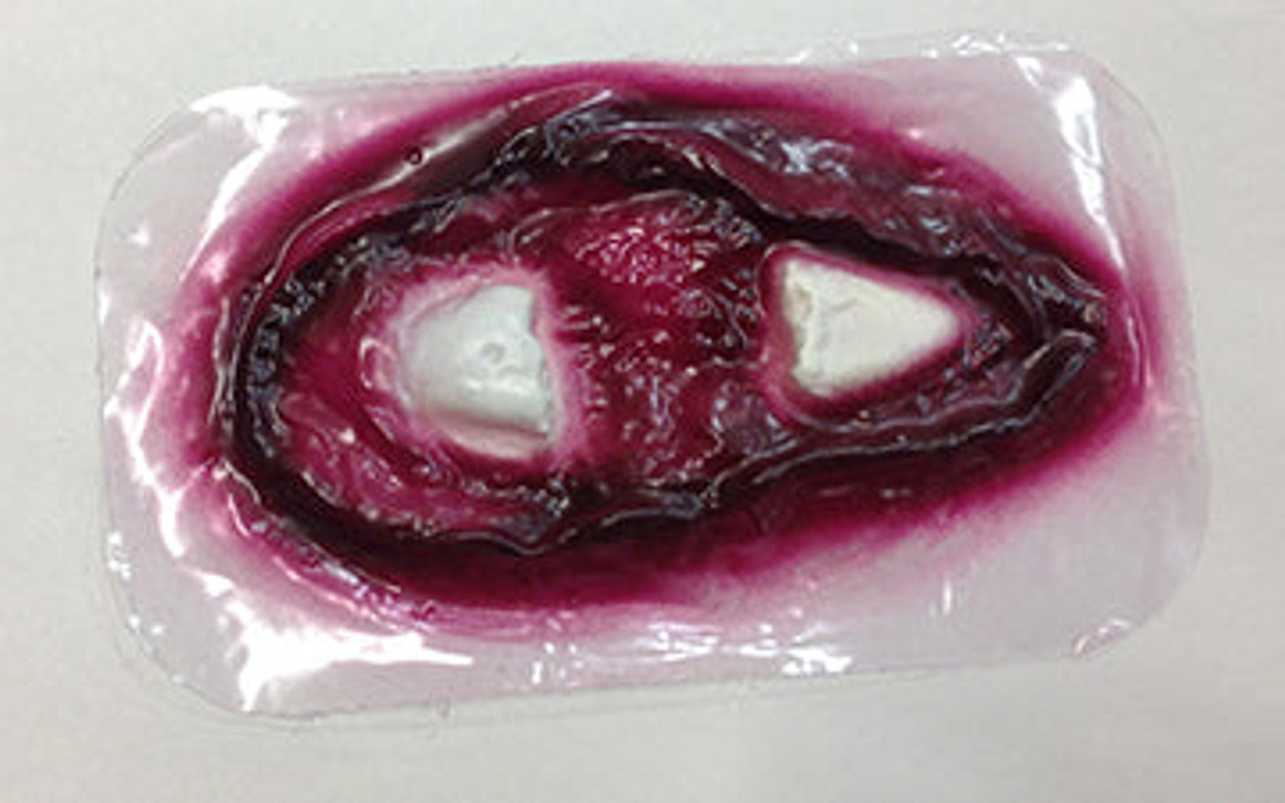 Comp Fracture Femur Stick-On, 800-908