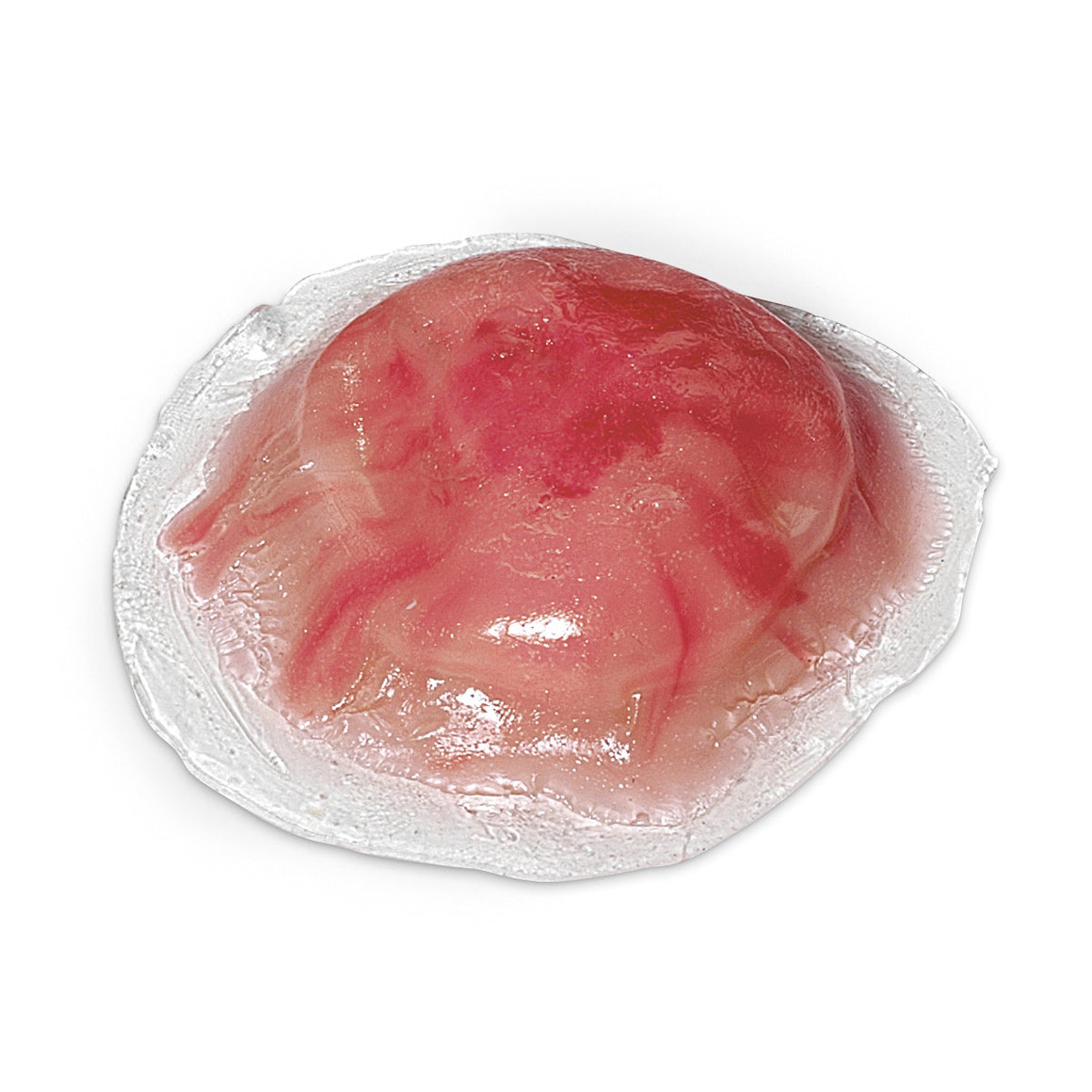 Cyst, Pus-Filled, LF00733