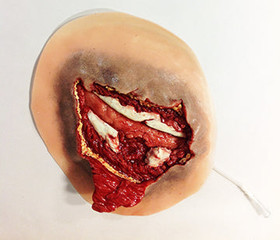 Open Rib Fracture, 800-603