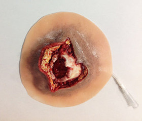 Open Humerus Fracture, 800-607