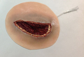 Major Muscle Laceration, 800-616