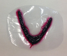 Blunt Bat Wound, 800-728