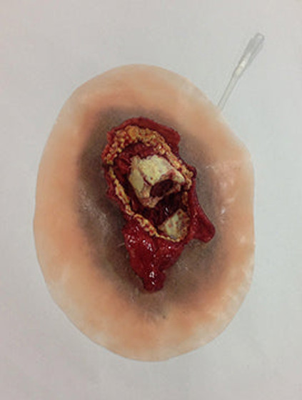 Xtreme Open Fracture Femur, 800-012