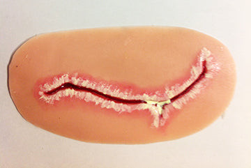 Surgical Site Infection Level3, 800-659