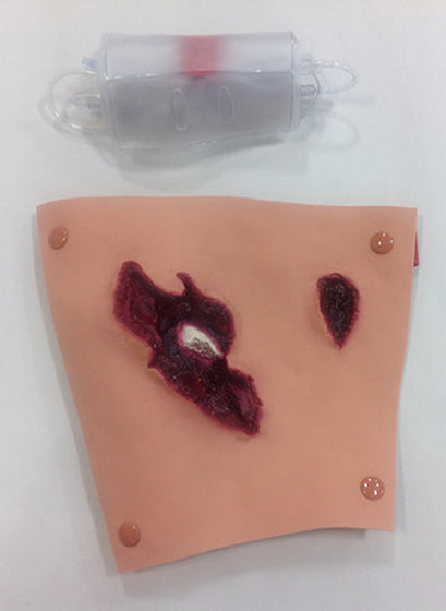 Compound Fracture Femur, 800-6819