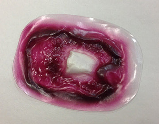 Comp.Fracture Humerus Stick-On, 800-907