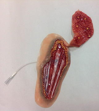 Xtreme Forearm Avulsion With Flap, 800-004