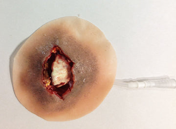 Open Wrist Fracture, 800-602