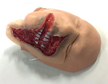 Exposed Denture Avulsion, 800-608