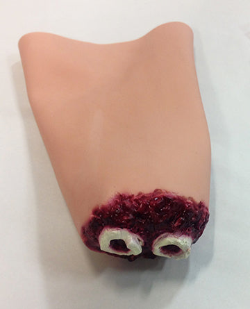 Hand Amputation, 800-621